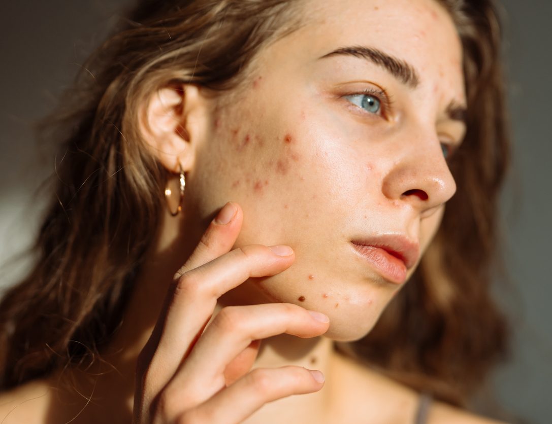 Acne and acne scarring skin treatment options at SlimCare Solutions, Orangevale CA